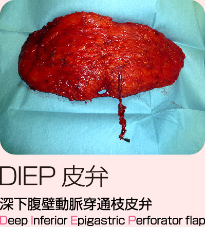 DIEP皮弁
